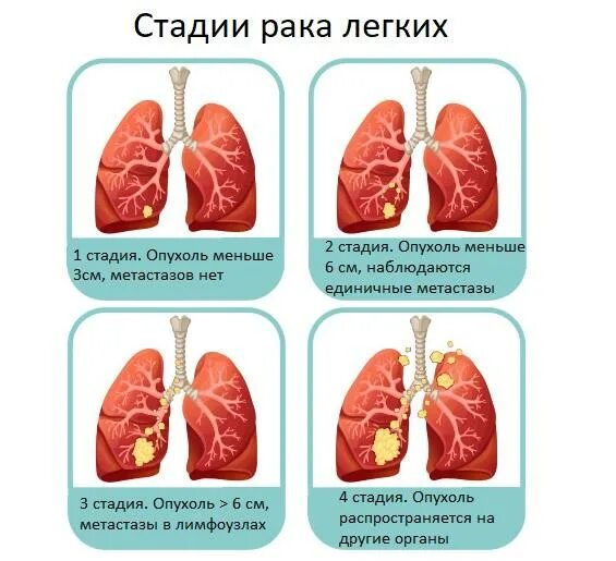 Рак легких симптомы у мужчин фото Можно ли выявить рак легких на ранних стадиях? - запись к врачам в Москве