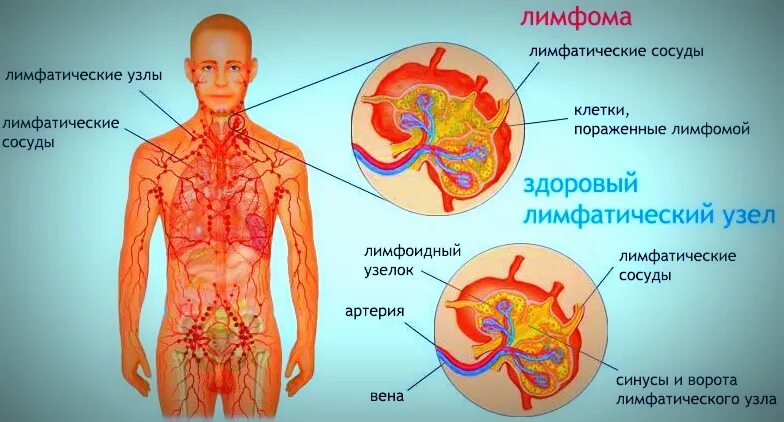 Рак лимфатической системы фото Метастазы в лимфоузлах - новые технологии лечения Медицинский центр Ассута