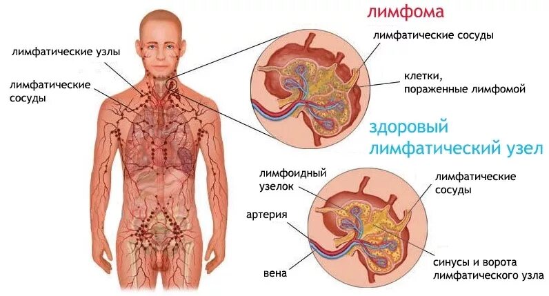 Рак лимфатической системы фото Лимфомы: Ходжкина, неходжкинская, стадии развития лимфомы Фосфоглив ®