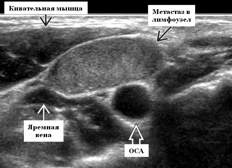 Рак лимфоузлов симптомы фото УЗИ лимфоузлов при метастазах рака щитовидной железы - УЗИ в Красноярске