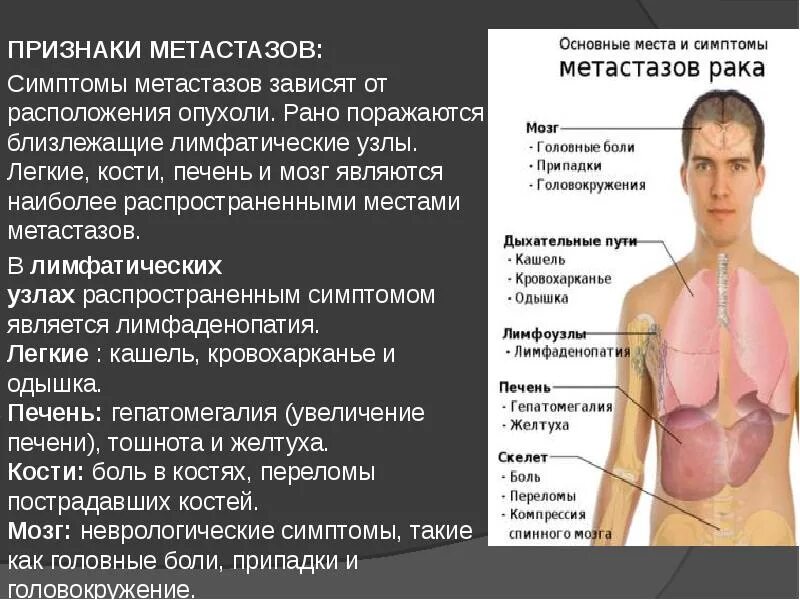 Рак лимфоузлов симптомы фото Картинки МЕТАСТАЗЫ В ЛИМФОУЗЛАХ КАКАЯ СТАДИЯ РАКА