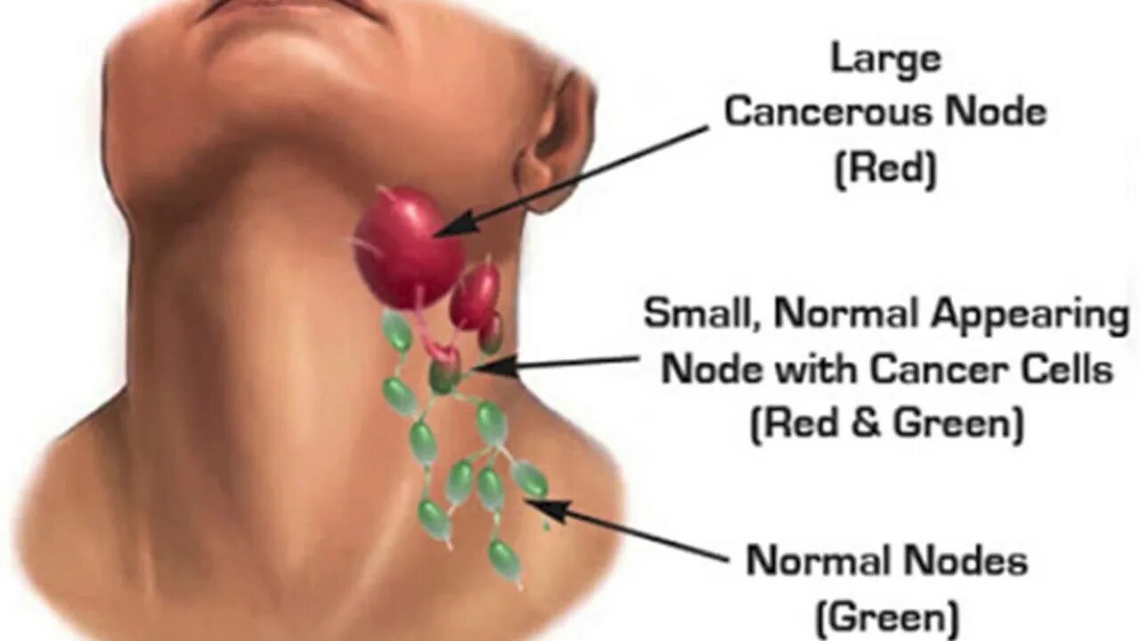 Рак лимфоузлов симптомы фото Картинки ЛИМФАТИЧЕСКИЕ УЗЛЫ УВЕЛИЧЕНЫ ЧТО ЗНАЧИТ
