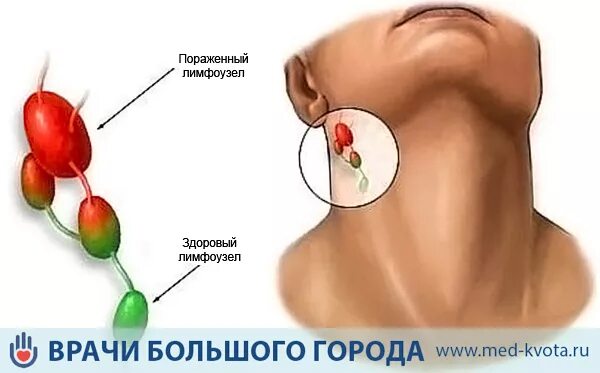 Рак лимфоузлов симптомы фото Лучевая терапия при раке лимфоузлов: стоимость, противопоказания, цена в Москве