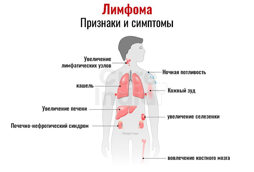 Рак лимфоузлов симптомы фото Ночная потливость - почему возникает и как избавиться - Азбука Сна и Дыхания