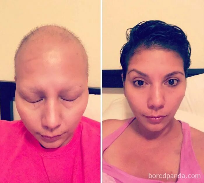 Рак лица фото у женщин People Who Beat Cancer In Powerful Before & After Pictures