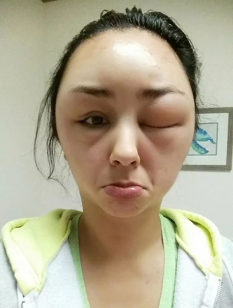 Рак лица симптомы у женщин фото Take a Look at the Allergic Reaction This Woman Got From an Everyday Beauty Prod