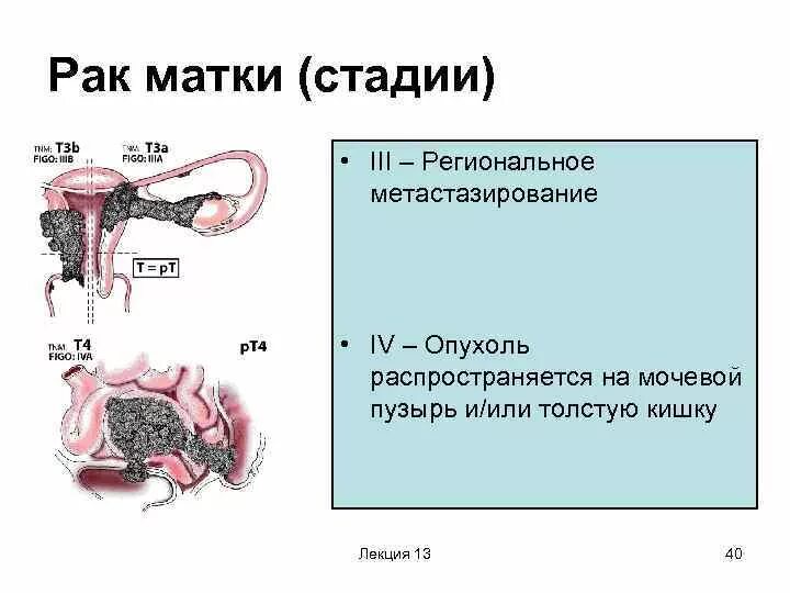 Рак матки первой стадии фото Боли при раке матки