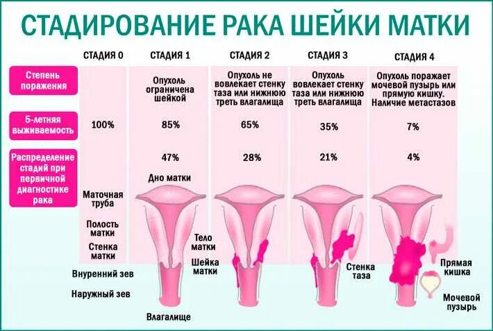 Рак матки первой стадии фото Матка может что это может быть: найдено 29 изображений