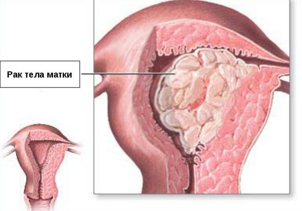 Рак матки признаки симптомы фото Первые признаки рака матки на ранней стадии. - Хирург К. В. Пучков