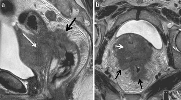 Рак матки симптомы фото Imaging of endometrial and cervical cancer Insights into Imaging