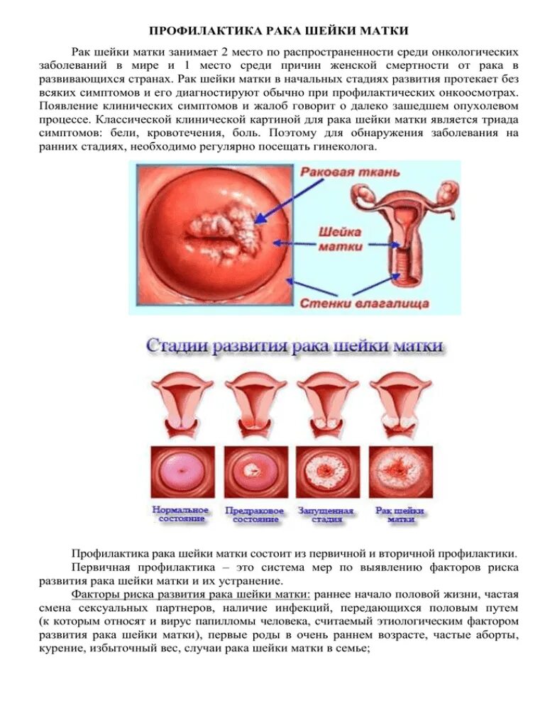 Рак матки симптомы фото Профилактика рака шейки матки