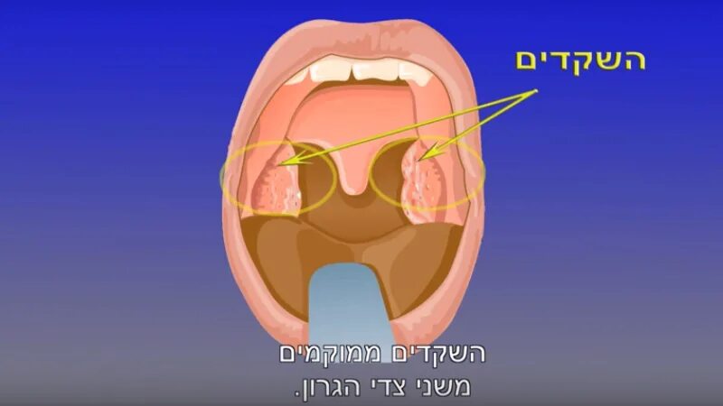 Рак миндалин фото начальная стадия как выглядит המדריך הרפואי אסותא