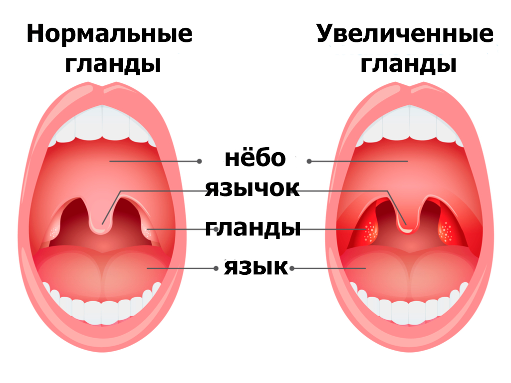 Рак миндалин симптомы фото и признаки Инфекционный мононуклеоз: симптомы, лечение, последствия