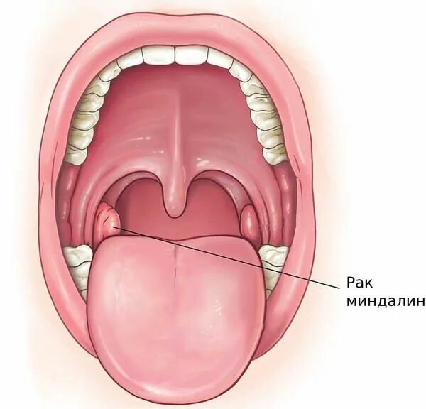 Рак миндалин симптомы фото у женщин Рак миндалин: причины, симптомы и лечение в статье ЛОР-хирурга Мамедов М. М.