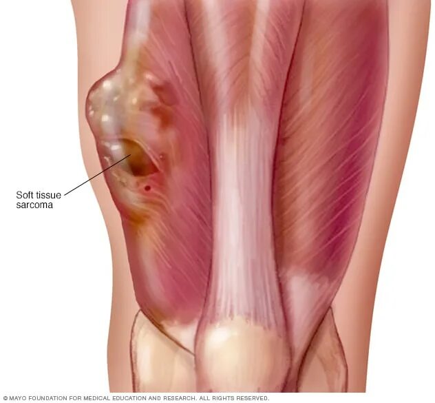 Рак мягких тканей фото Soft tissue sarcoma - Mayo Clinic