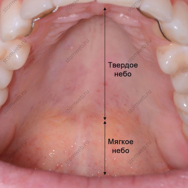 Рак мягкого неба фото Мягкое небо - STOMWEB - Твердое и мягкое нёбо