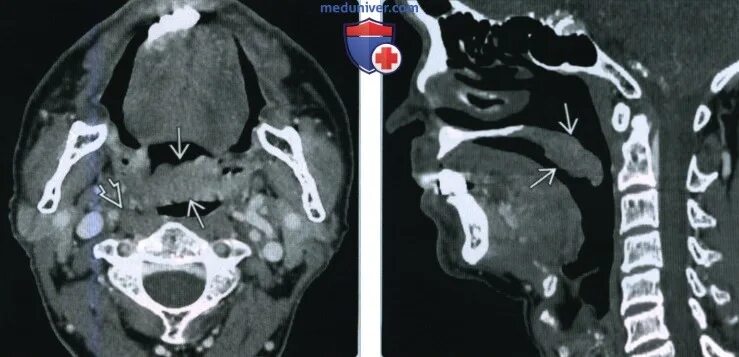Рак мягкого неба фото симптомы Плоскоклеточный рак мягкого неба - лучевая диагностика