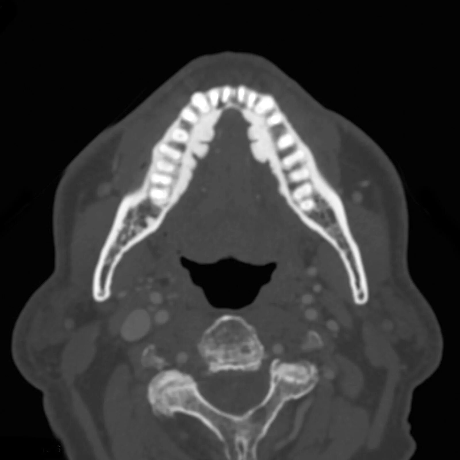 Рак мягкого неба фото симптомы Image Radiopaedia.org