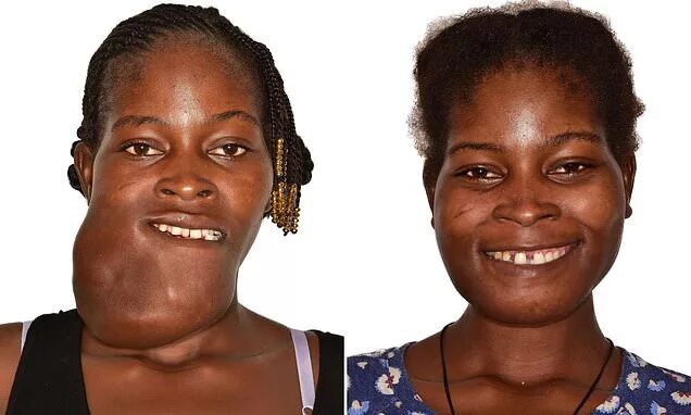 Рак на лице фото начальная Woman, 23, stoned by African villagers has giant facial tumour removed after eig