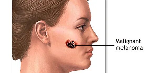 Рак на лице фото начальная стадия Los siete signos de alarma del melanoma - Periodista Digital