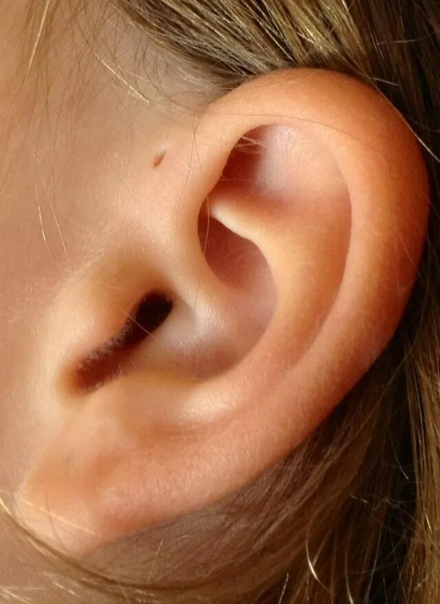 Рак на ухе у человека фото File:Preauricular sinus and cyst.jpg - Wikipedia