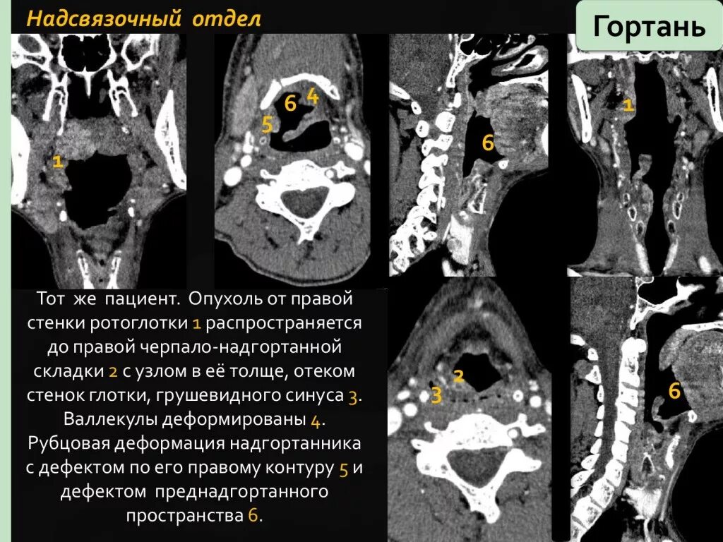 Рак надскладочного отдела гортани фото КТ-диагностика злокачественных опухолей ротовой полости, глотки, гортани