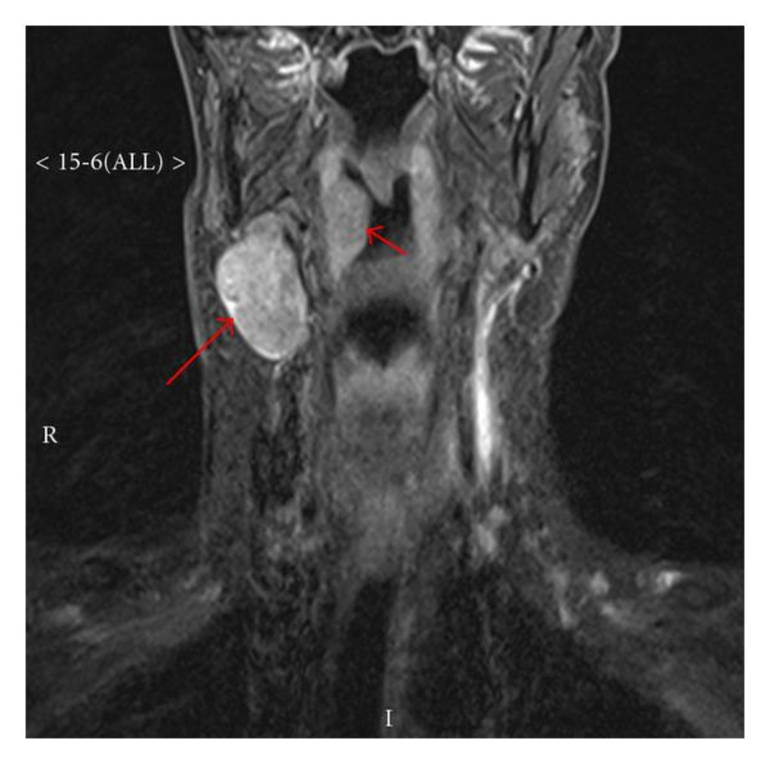 Рак надскладочного отдела гортани фото MRI of the neck showing an enlarged lymph node (long arrow) and a bulge... Downl