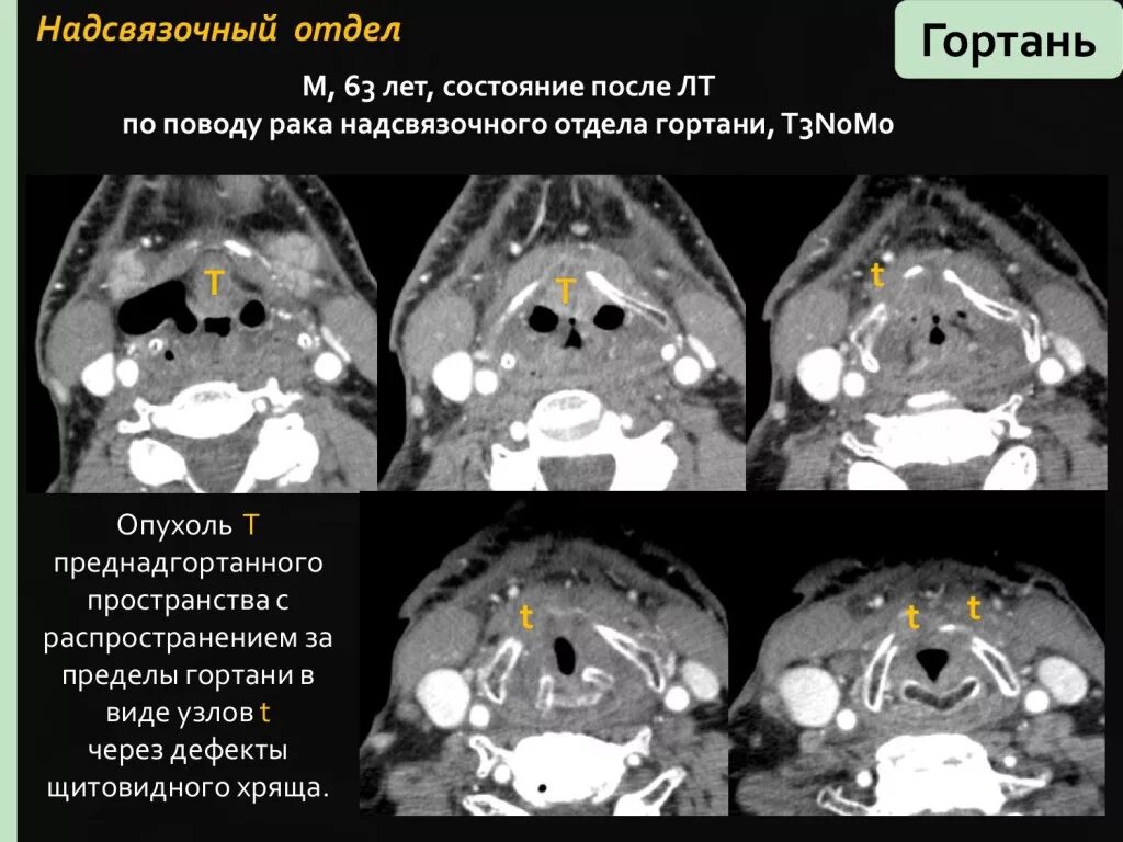 Рак надскладочного отдела гортани фото Мрт миндалин