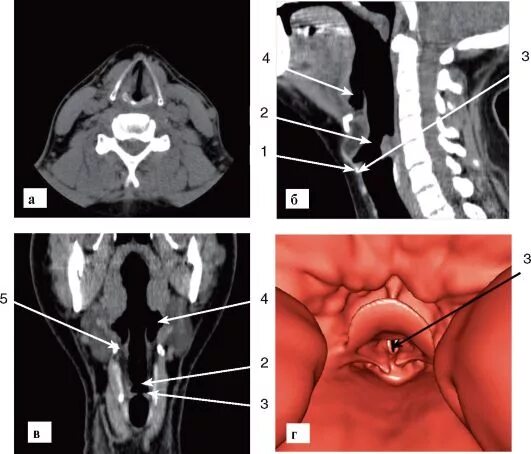 Рак надскладочного отдела гортани фото ГЛАВА 5 ГОЛОВА И ШЕЯ