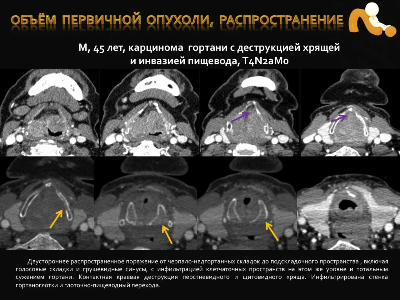 Рак надскладочного отдела гортани фото Презентация на тему: "Военно-медицинская академия Компьютерная A1C