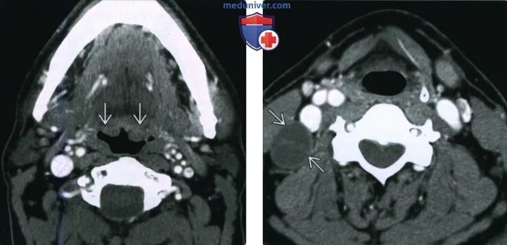 Рак неба фото ВПЧ-обусловленный плоскоклеточный рак ротоглотки - лучевая диагностика