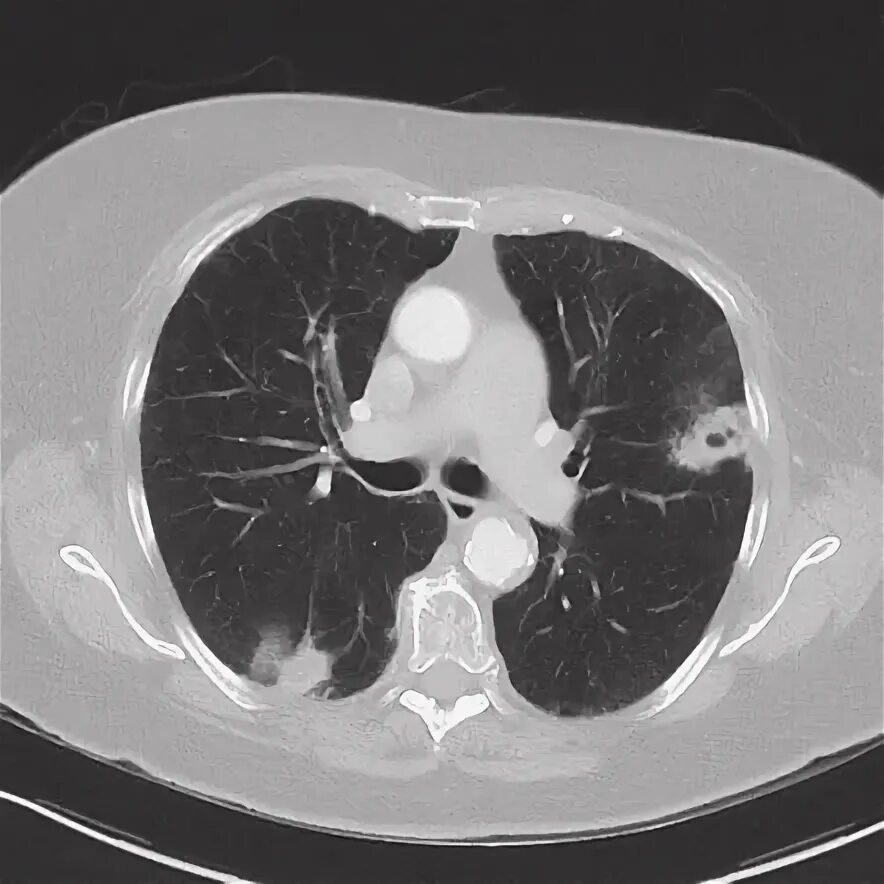 Рак неба фото начальная Synchronous primary lung carcinoma Radiology Reference Article Radiopaedia.org