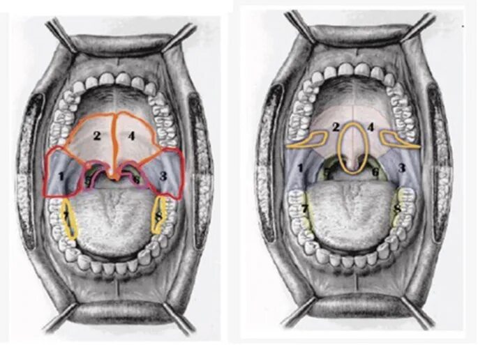 Рак неба фото начальная стадия Minimally invasive erbium laser treatment for selected snorers Lasers in Medical