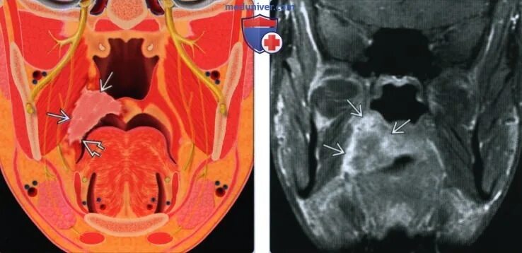 Рак неба симптомы фото КТ, МРТ при плоскоклеточном раке мягкого неба