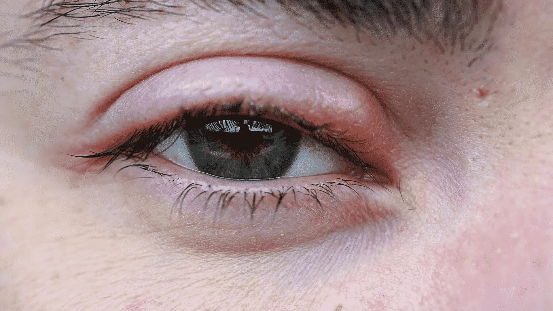 Eyelid Cancer - All About Vision