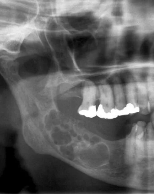 Рак нижней челюсти фото Ameloblastoma Radiology Case Radiopaedia.org Radiology, Bone diseases, Dental