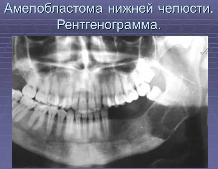 Рак нижней челюсти фото Причины и факторы риска онкологии рта - злокачественные опухоли полости рта Нова