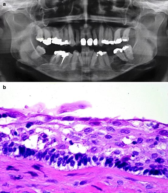 Рак нижней челюсти симптомы фото Odontogenic Tumours Pocket Dentistry