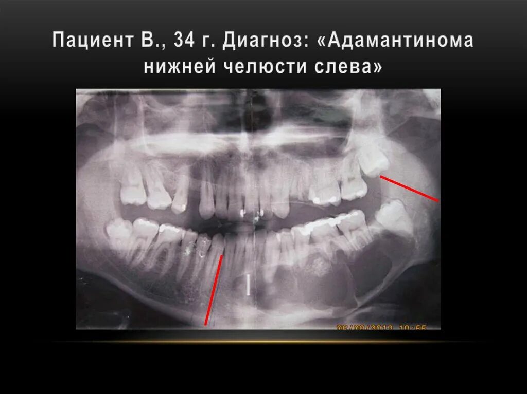 Рак нижней челюсти симптомы фото Особенности костнопластических операций при дефектах нижней челюсти - презентаци