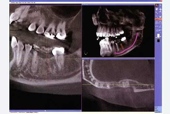 Рак нижней челюсти симптомы фото Применение Implant guide при имплантации в ТОП1 клинике Москвы - Немецкий имплан