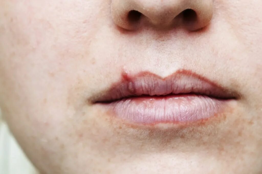 Рак нижней губы фото Half of Americans have cold sore virus; 12 percent genital herpes