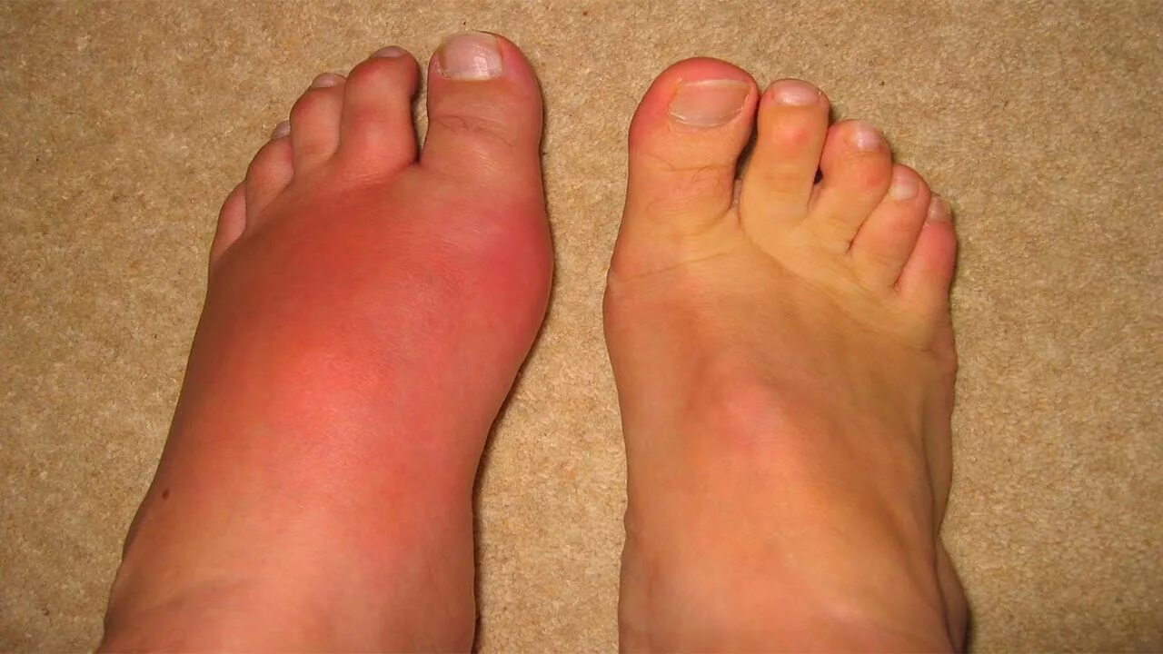 Рак ноги симптомы фото Gout Gout causes How to treat gout Home Remedies for Gout - YouTube