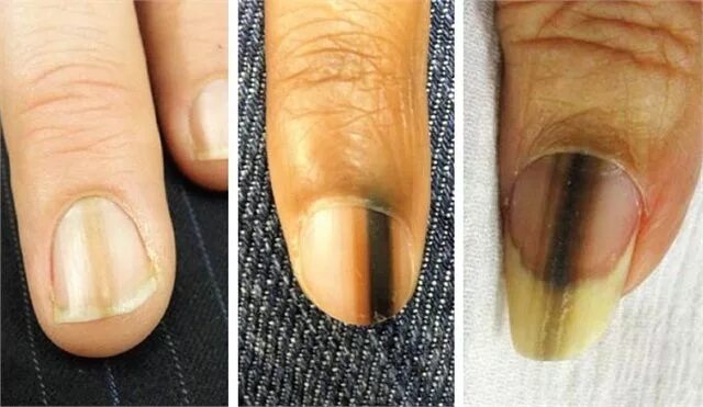 Рак ногтя фото начальная стадия Pin on Nail Health and Safety