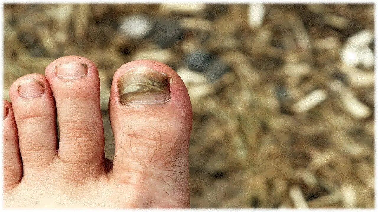 Рак ногтя на ноге фото How To Cure Toenail Fungus With Tea Tree Oil - A Complete Step By Step Guide - Y