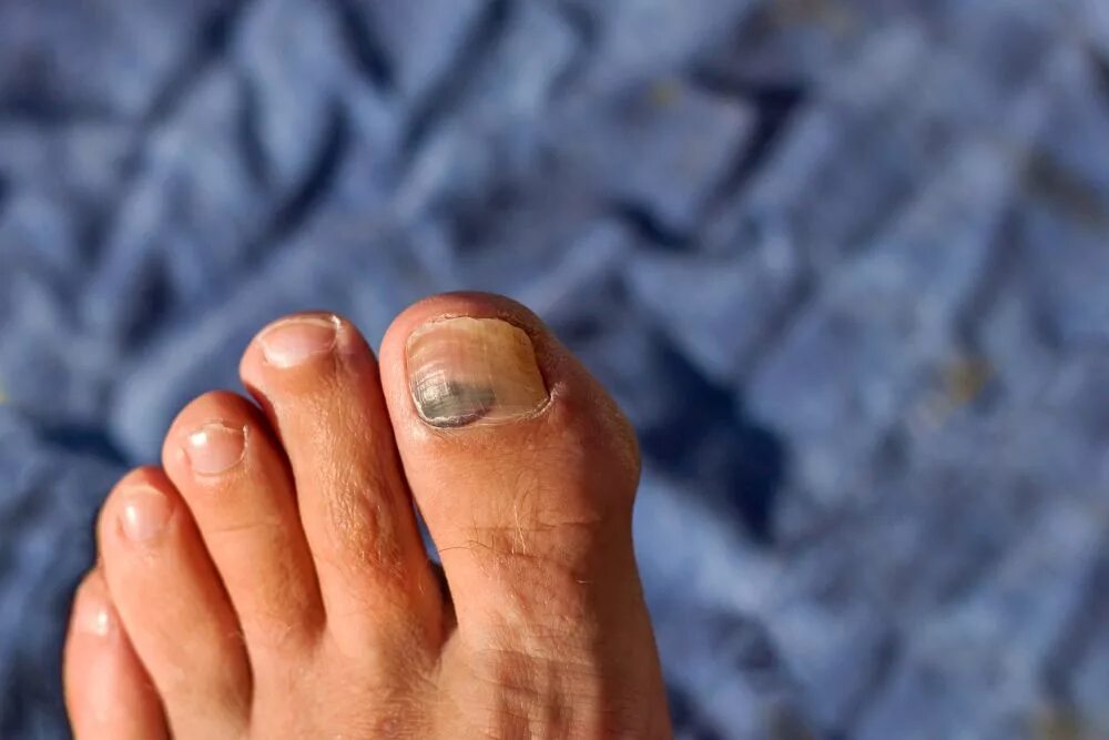 Рак ногтя на ноге симптомы фото The nine types of toenails you will find in the running scene... - Canadian Runn