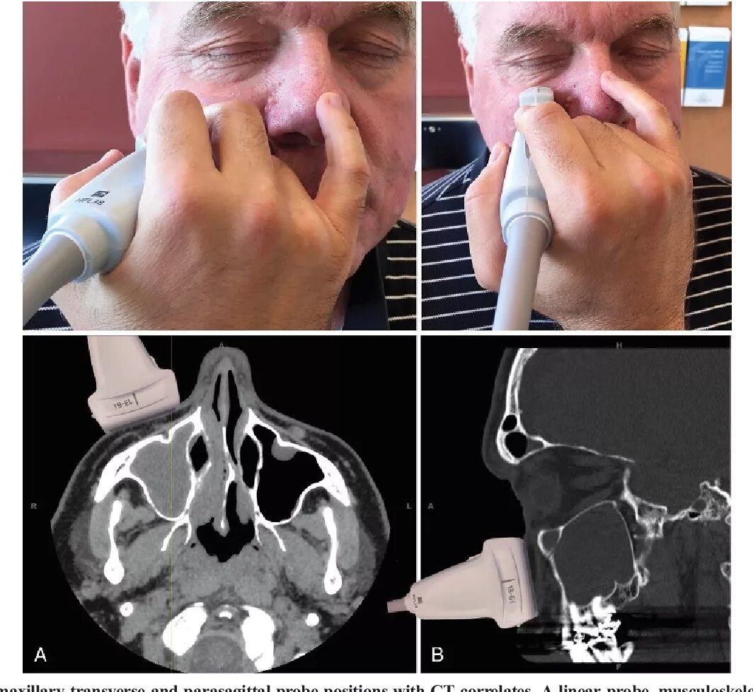 Рак носа фото снаружи Point-of-Care Sinus Ultrasound: Impact Within a Large Internal Medicine Clinic a