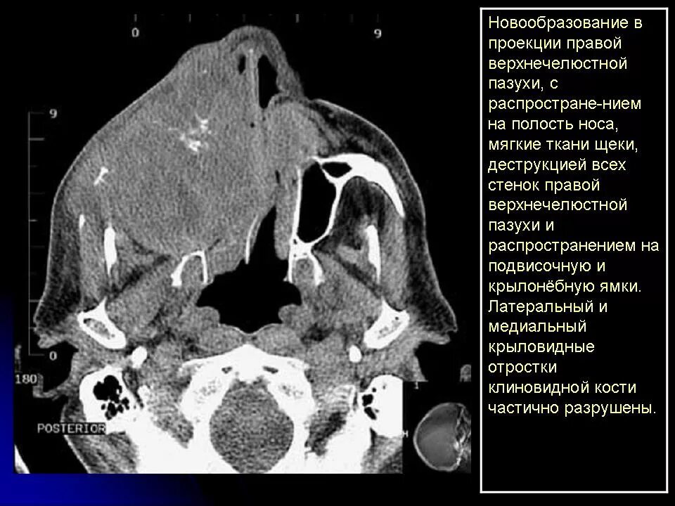Рак носа симптомы и признаки фото ЛОР. ППН. КТ. Визуализация опухолей. + Портал радиологов