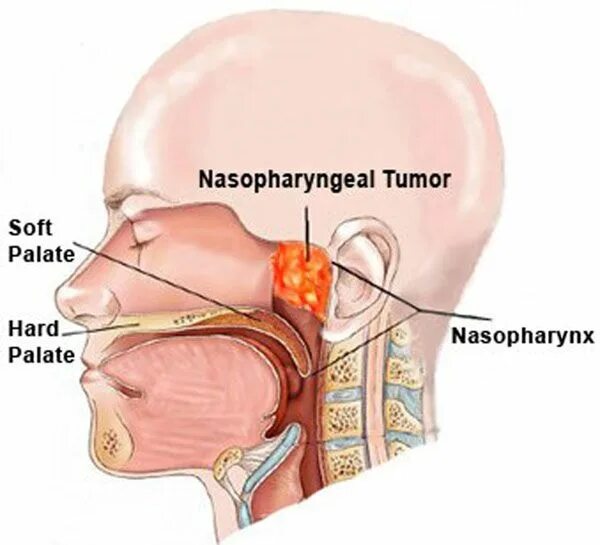 Рак носоглотки фото начальная стадия Pin on Oral and Maxillofacial Surgery