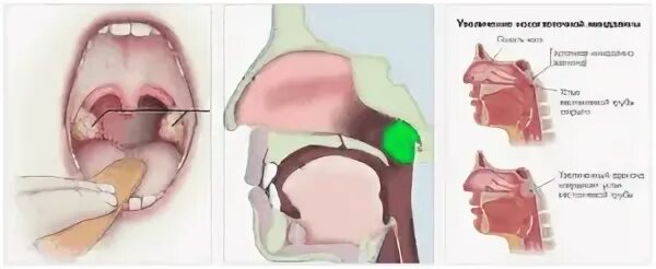 Рак носоглотки симптомы и признаки фото Как лечить сопли у ребенка, если жидкость стекает из носа в горло по задней стен