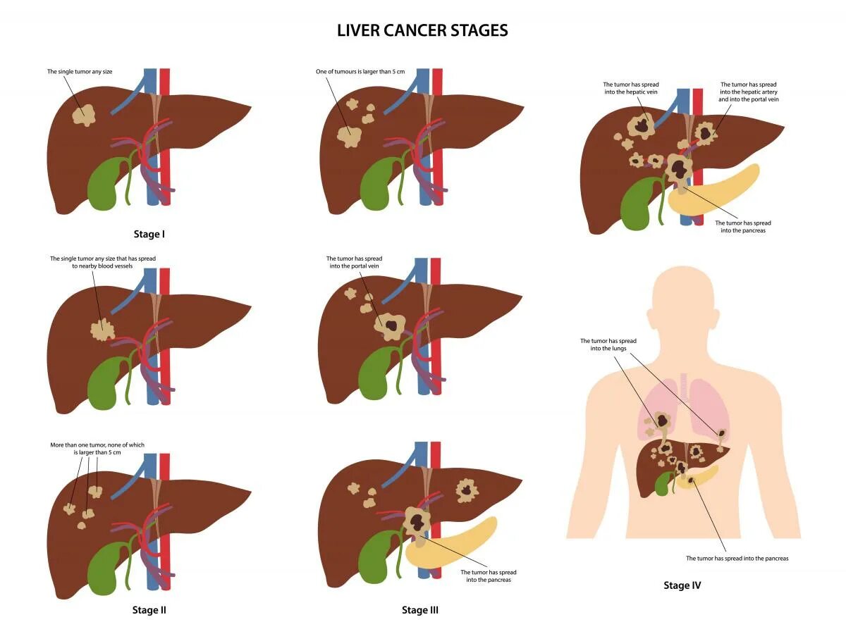 Рак печени 4 стадия фото Смертельный враг: рак печени и его разрушительное воздействие